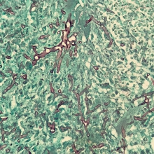 Mundo paralelo -  fotomicrografia de linfonodo suíno mostrando invasão por hifas fúngicas (coradas em preto - Mucormicose). Microscópio óptico, obj. 40x. - Affa Fabiana Galtarossa Xavier